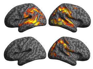 Controls (top row)  compared to toddlers with autism who have poor language skills (bottom row). 